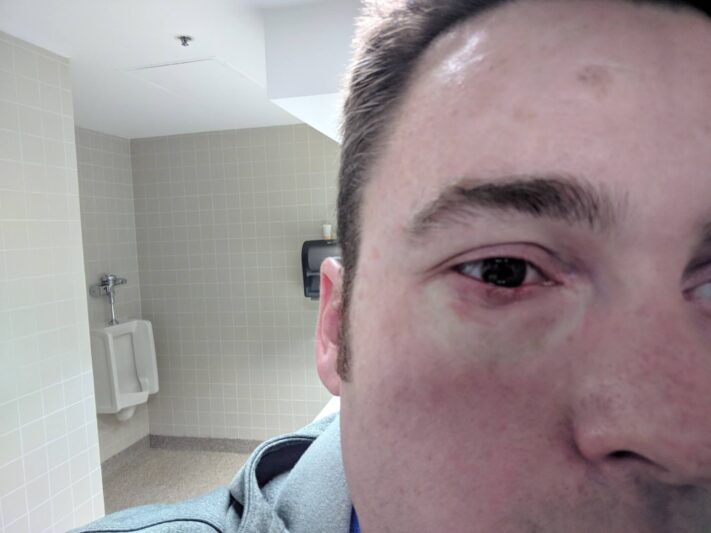 Chalazion removal on eye (bump on eyelid)